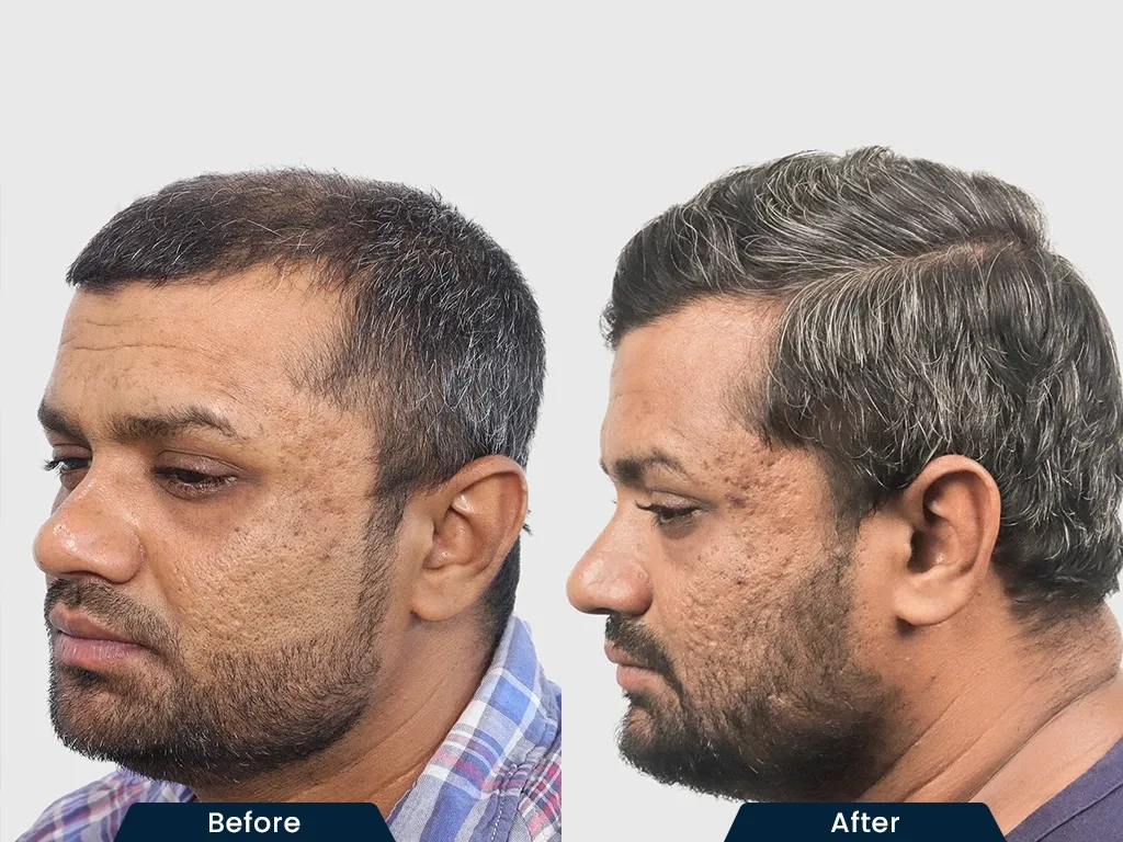 Crown Baldness result