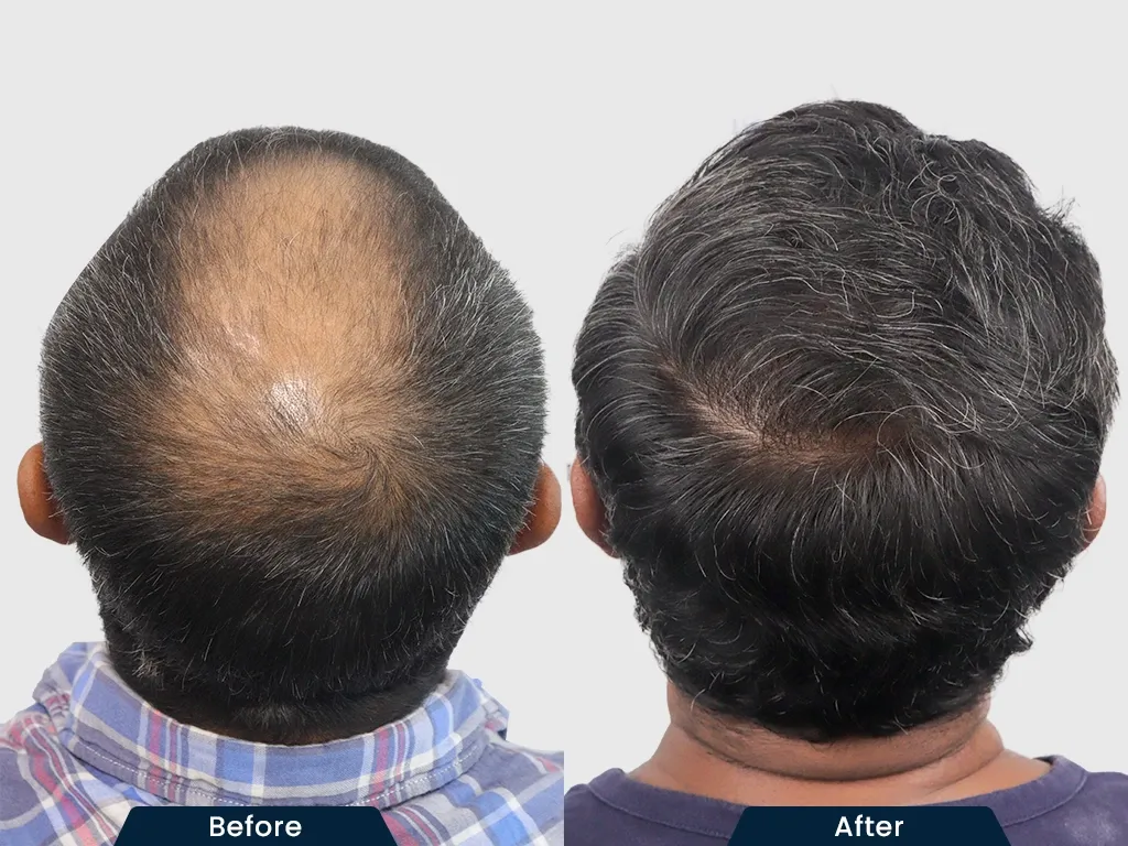 Crown Baldness result