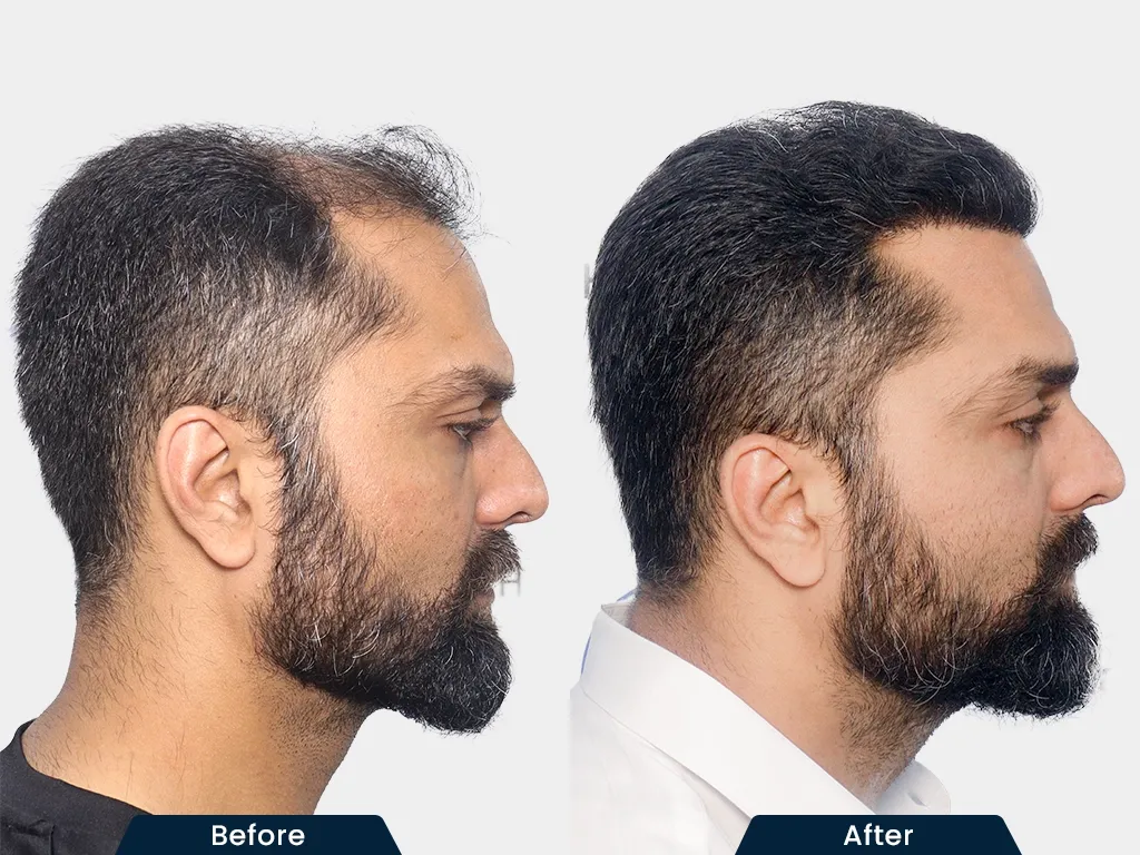 Full Baldness Solutions result