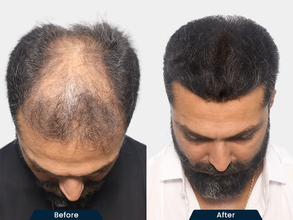 Full Baldness Solutions result