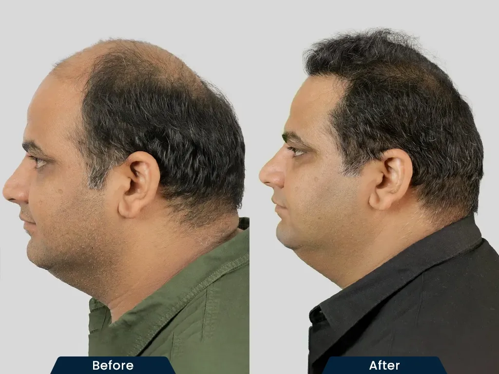 High Density Hair HT result