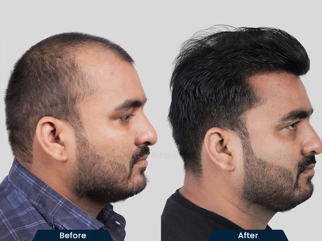 Hairline Restoration result
