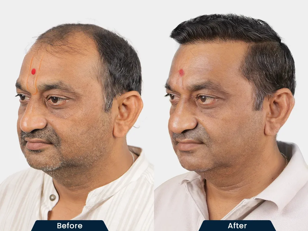 Natural Hair Transplant result