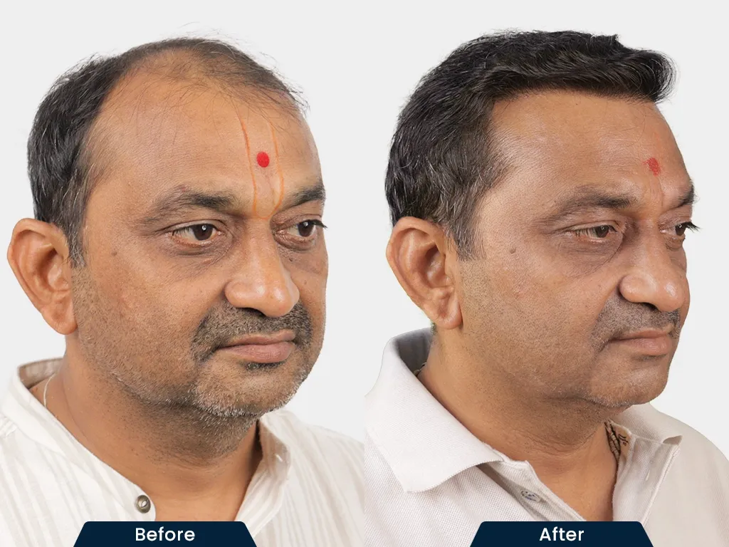 Natural Hair Transplant result